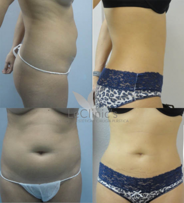Lipoescultura